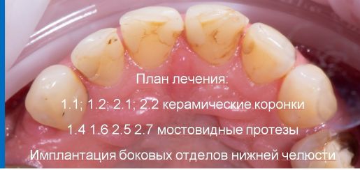 старые пломбы на передних зубах, план лечения