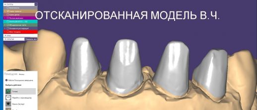скан гипсовой модели в стоматологии