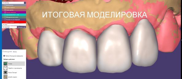 итоговая моделировка в стоматологии